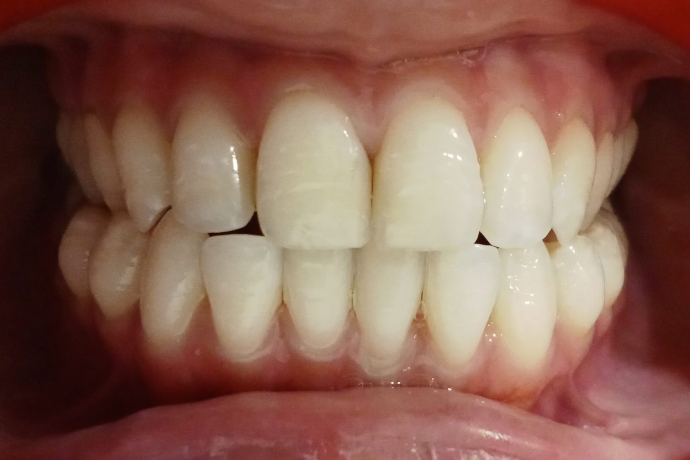 Before — edge-to-edge anterior bite