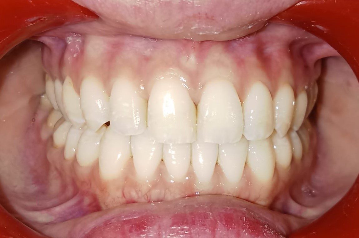 After — normal bite restored with Invisalign