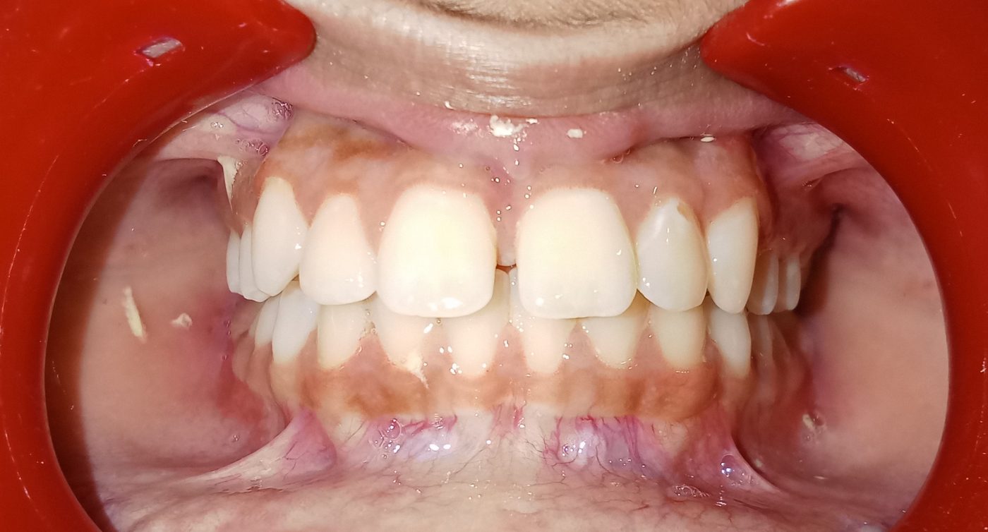 Before — midline gap between front teeth