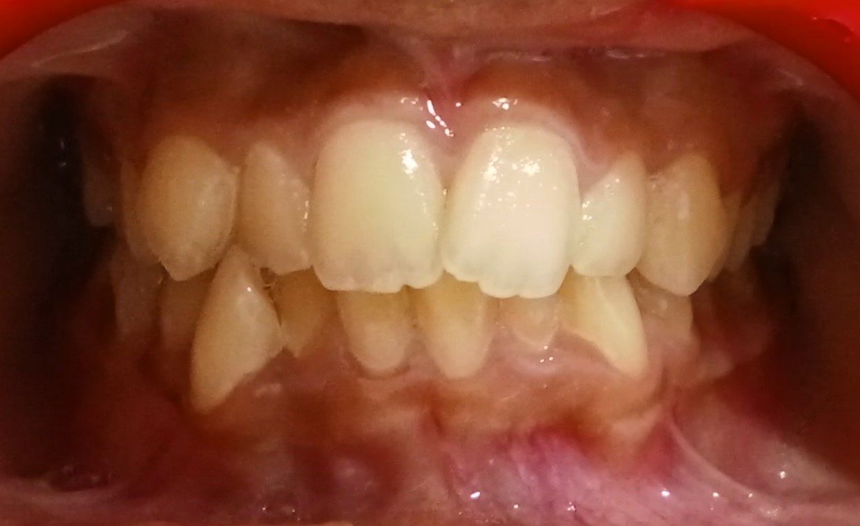 Before — complex crowding and crossbite