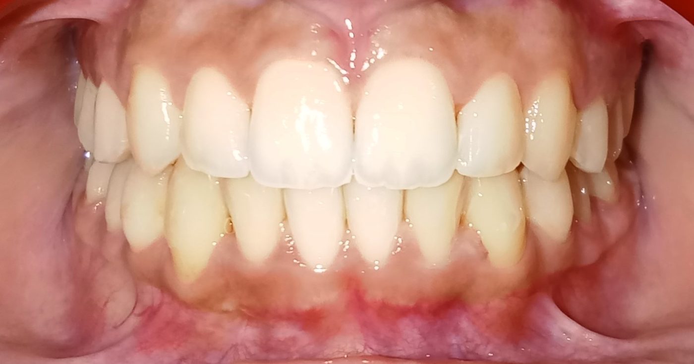 After — fully aligned with Invisalign